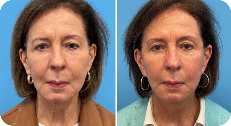 Before and after facelift: woman's face showing enhanced cheekbone definition and tightened jawline