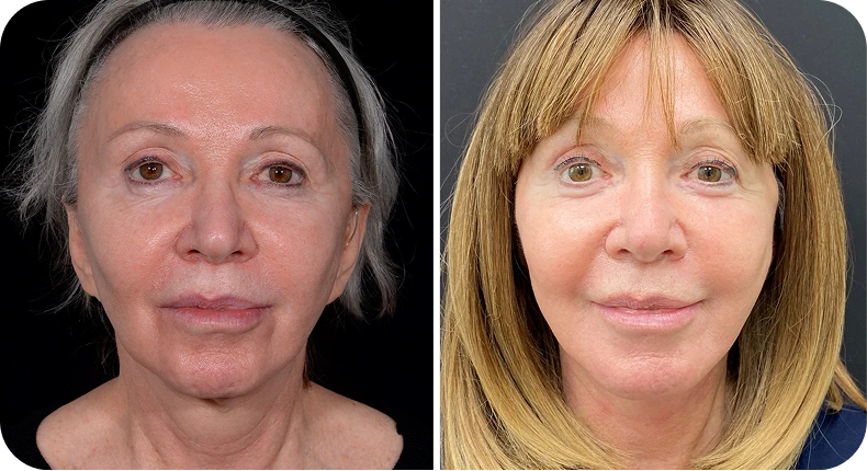 Before and after facelift: woman's face showing improved skin firmness and reduced facial drooping