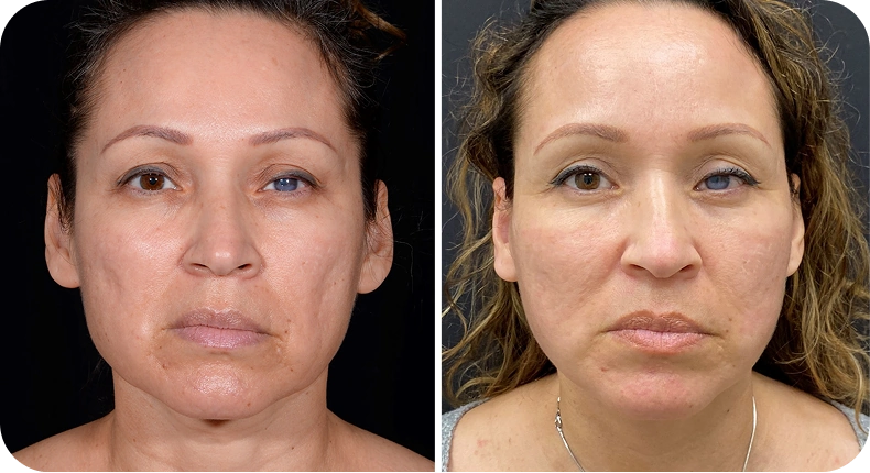 Before and after facelift: woman's face showing decreased jowls and smoother neck appearance