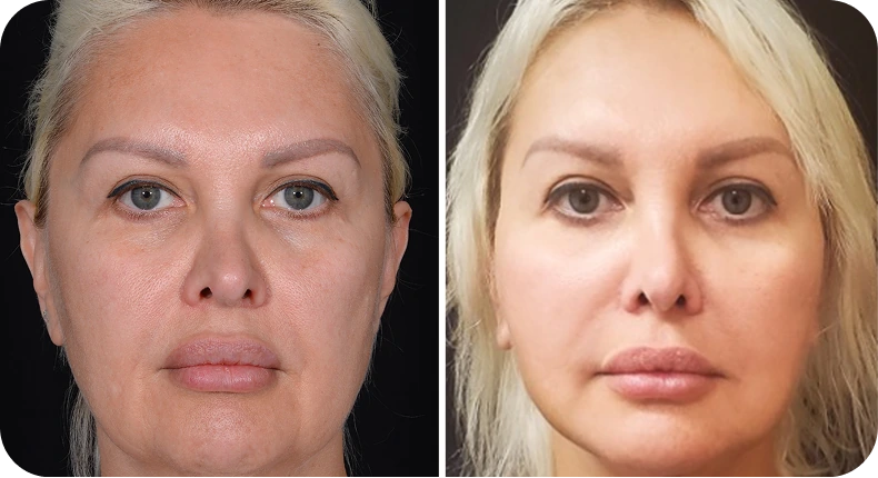 Before and after facelift: woman's face showing tighter skin and lifted facial contours