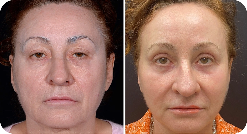 Before and after facelift: woman's face showing reduced sagging and improved jawline definition