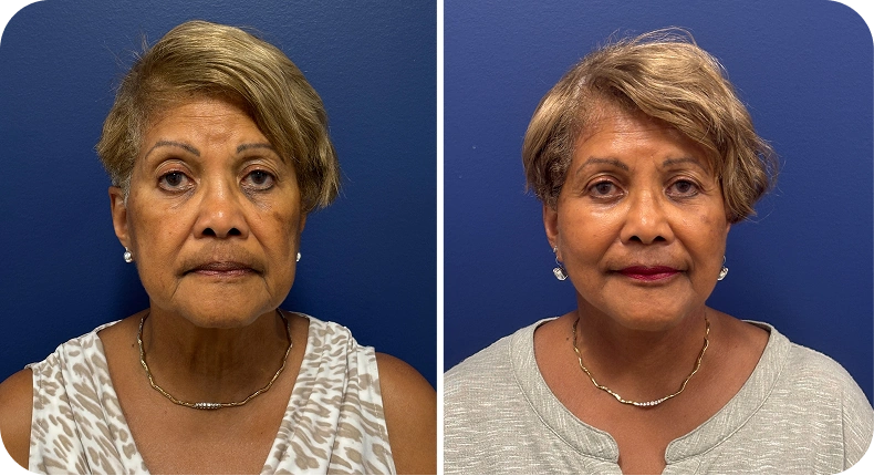 Before and after facelift results showing reduced sagging and improved facial structure on a woman