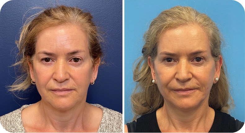 Before and after facelift results showing lifted cheeks and improved facial definition on a woman