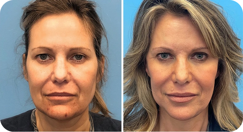 Before and after facelift results showing enhanced facial contours and skin tightening on a woman