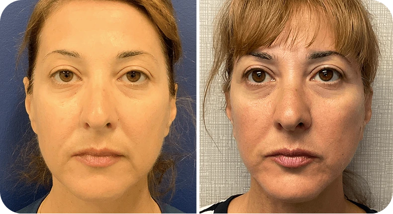 Before and after facelift results showing improved jaw definition and facial rejuvenation on a woman