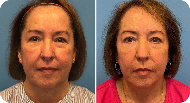 Before and after facelift results showing lifted facial structure and reduced jowls on a woman with brown hair