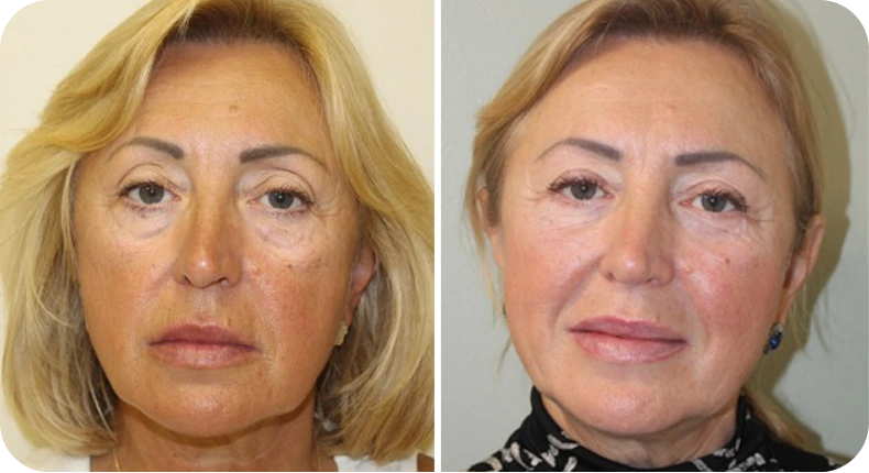 Before and after facelift results showing improved facial contours and reduced sagging on a woman with blonde hair