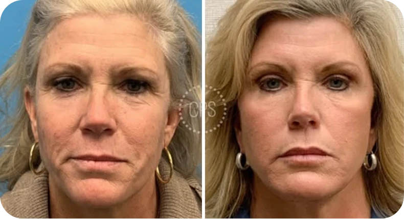 Before and after facelift showing woman's face from front with improved skin definition and facial rejuvenation