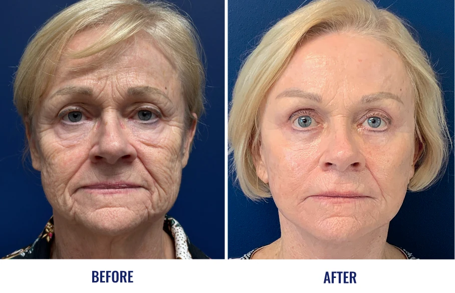 Before and after facial comparison showing reduced wrinkles and improved skin texture