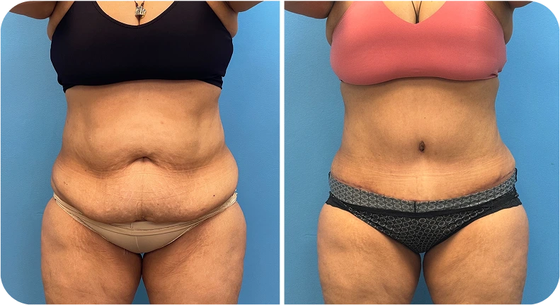 Before and after liposuction of abdomen and flanks showing reduced contour from front view
