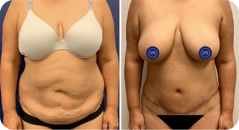 Before and after liposuction of abdomen and flanks showing reduced fullness from front view