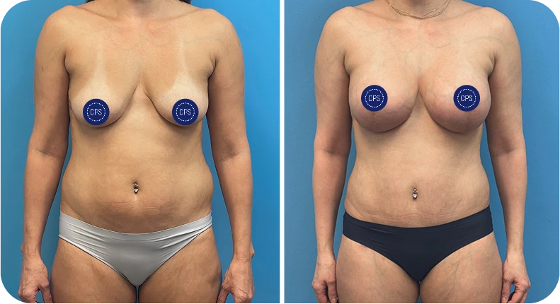 Before and after breast augmentation showing increased volume and lift from front view