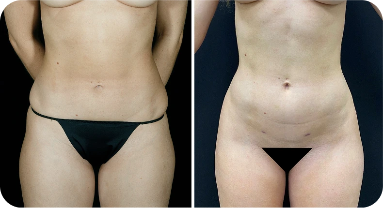 Before and after liposuction of abdomen and flanks showing reduced contour from front view