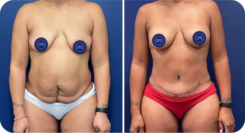 Before and after liposuction comparison showing front torso with reduced midsection on right