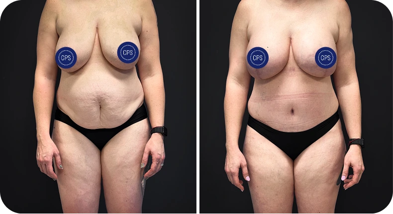 Before and after breast augmentation results showing front torso view with CPS badges