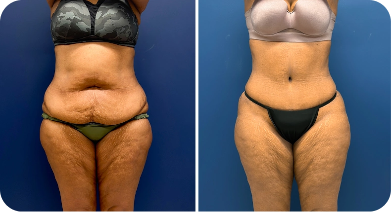 Before and after comparison of body contouring results, frontal view
