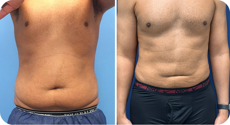 Before and after liposuction results showing front torso view with reduced abdominal fullness