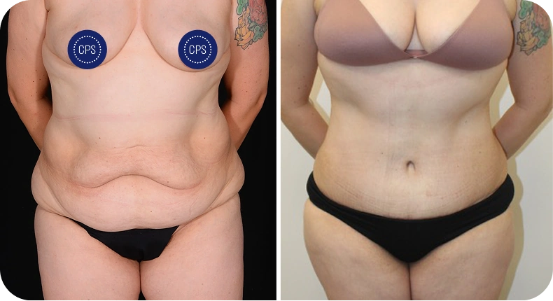 Before and after breast lift and tummy tuck results showing front torso view with CPS badges