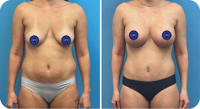 Before and after comparison of breast augmentation results, frontal view