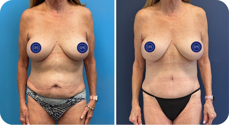 Before and after comparison of breast augmentation results, frontal view