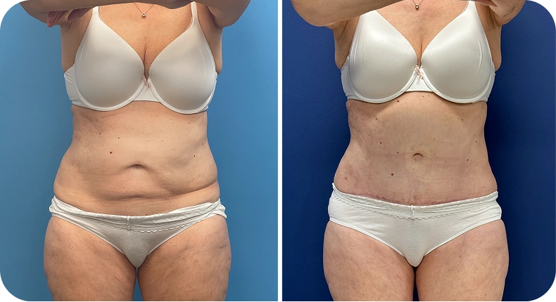 Before and after comparison of abdominal contouring results, frontal view