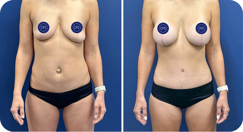 Before and after comparison of breast augmentation results, frontal view