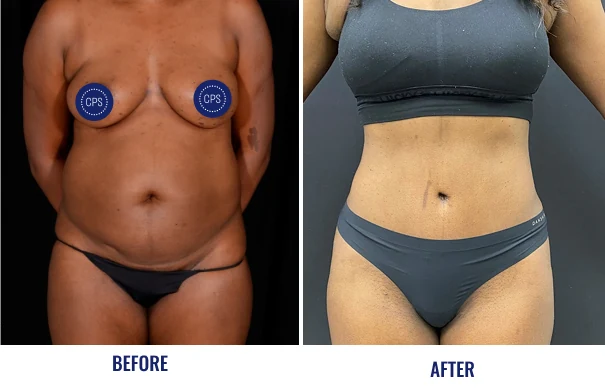 Before and after body contouring results labeled before on left and after on right