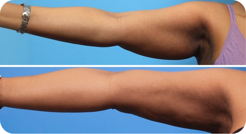 Before and after comparison of arm contouring results, side view