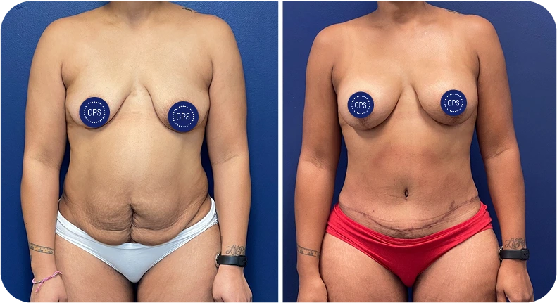 Before and after mommy makeover surgery showing breast and abdominal results