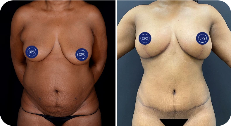 Before and after mommy makeover results showing frontal torso comparison with breast and body contouring
