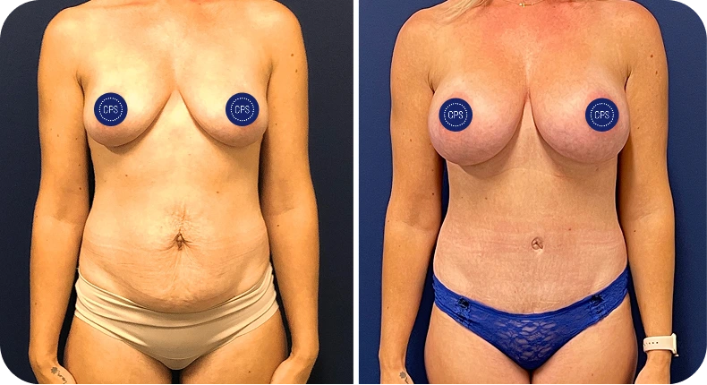Before and after breast augmentation and abdominal contouring results