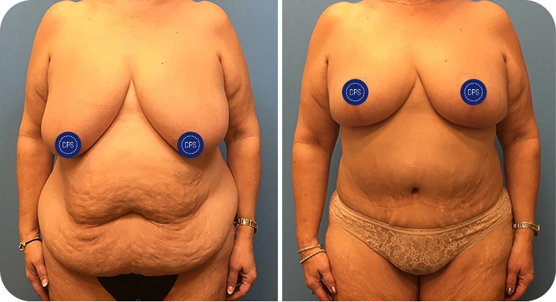 Before and after breast lift and tummy tuck surgical results