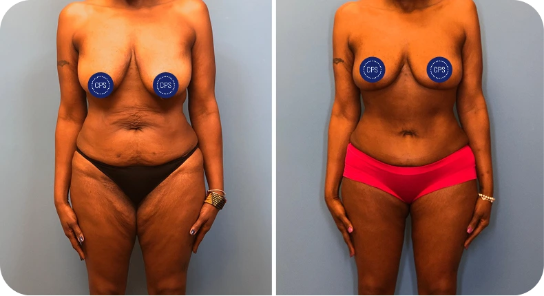 Before and after breast augmentation and abdominoplasty outcomes