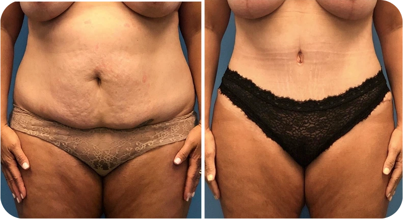 Before and after tummy tuck and abdominal contouring results