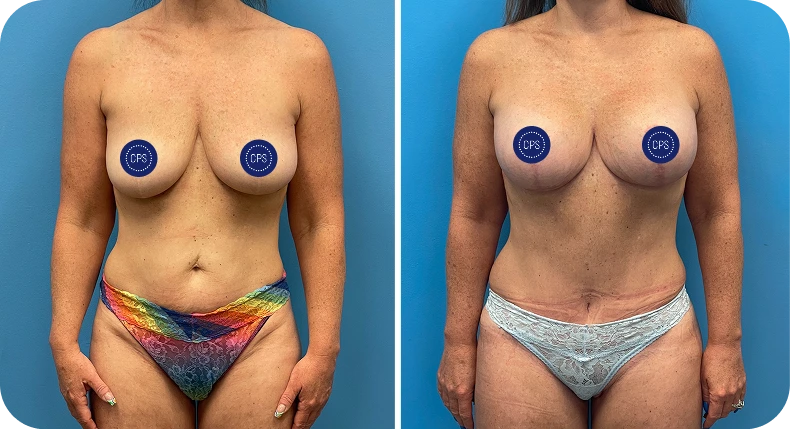 Before and after breast augmentation surgical results