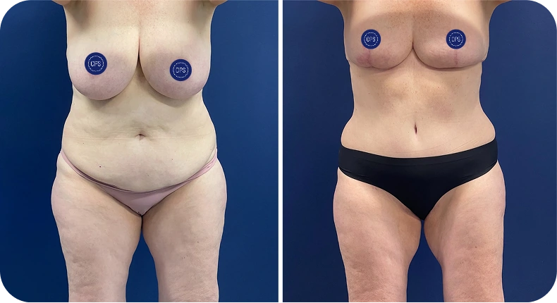 Before and after body contouring results showing front torso view with measurement markers