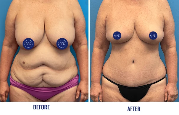 Before and after abdominoplasty and breast lift showing frontal view with labeled before and after sections