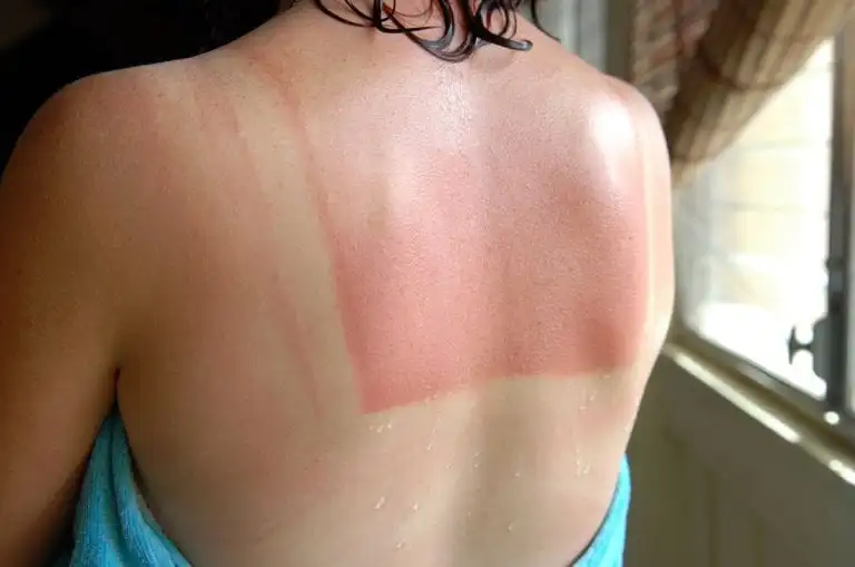 Bitar Institute How to Treat a Bad Sunburn (+ a Few Tips for Avoiding it in the First Place!)