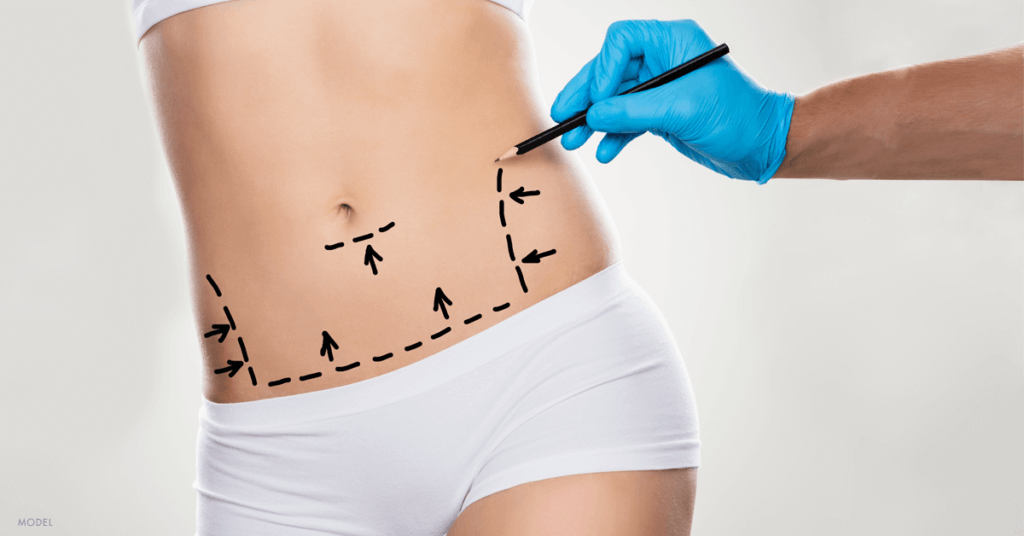 Bitar Institute Your Tummy Tuck Recovery Timeline