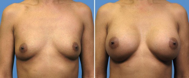 Breast Augmentation before and after