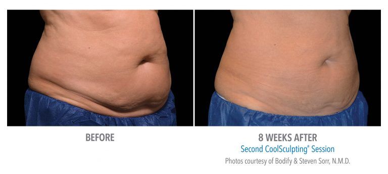 CoolSculpting before and after