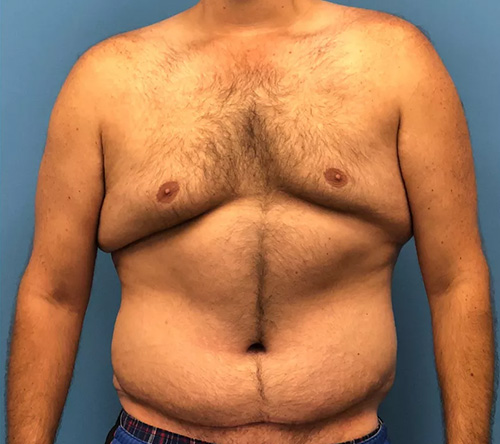 Mens lipo after