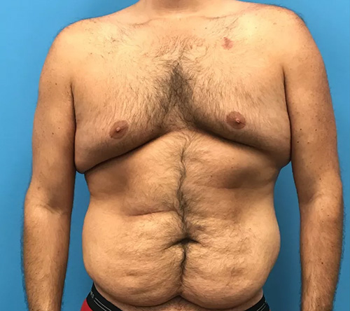 Mens Lipo before