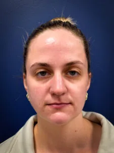 Submental-Liposuction-Case--4705 | After Face 1