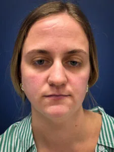 Submental-Liposuction-Case--4705 | Before Face 1