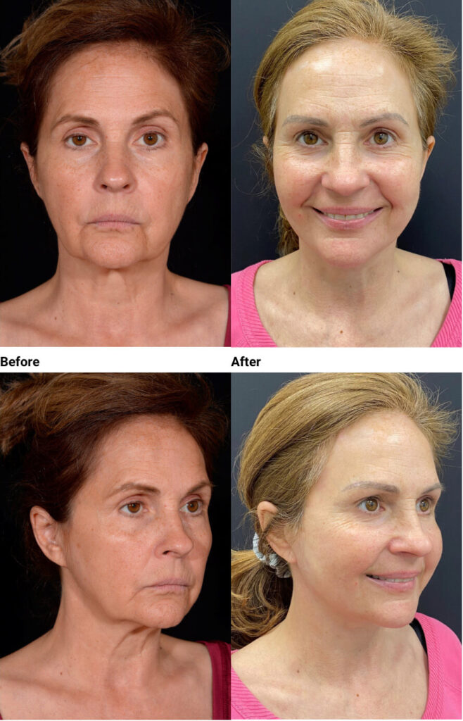 Actual Patient Results 2