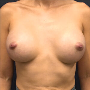 Breast-Augmentation-Case--8208 | After Dr. Arjun Kanuri 1