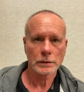 Rhinoplasty-Case--3129 | After Rhinoplasty for Men 1