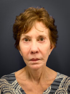 Facial-Fat-Grafting-Case--5079 | After Facial Fat Grafting 1