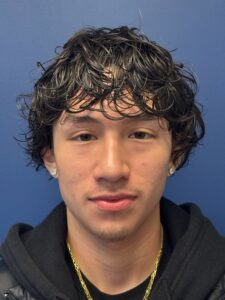 Rhinoplasty-Case--2339 | After Rhinoplasty 1